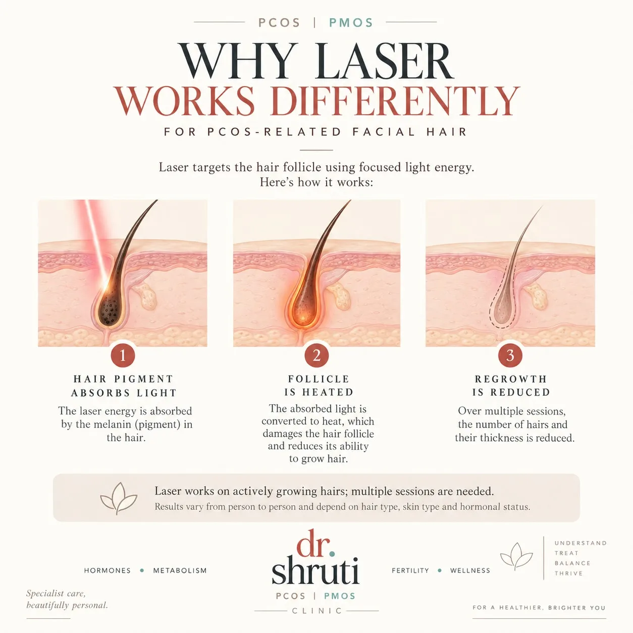 Why laser works differently for PCOS-related facial hair - Dr. Shruti Shah