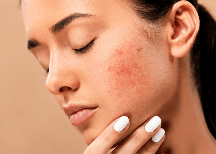 Dr. Shruti Shah diagnosing patient's skin and prescribing hormonal acne treatment